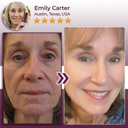 Hudros® Calcium Volume Botox Balm (KRHIA)