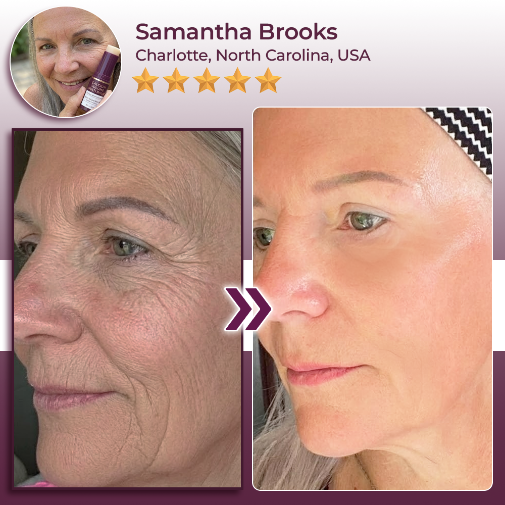 Hudros® Calcium Volume Botox Balm (KRHIA)